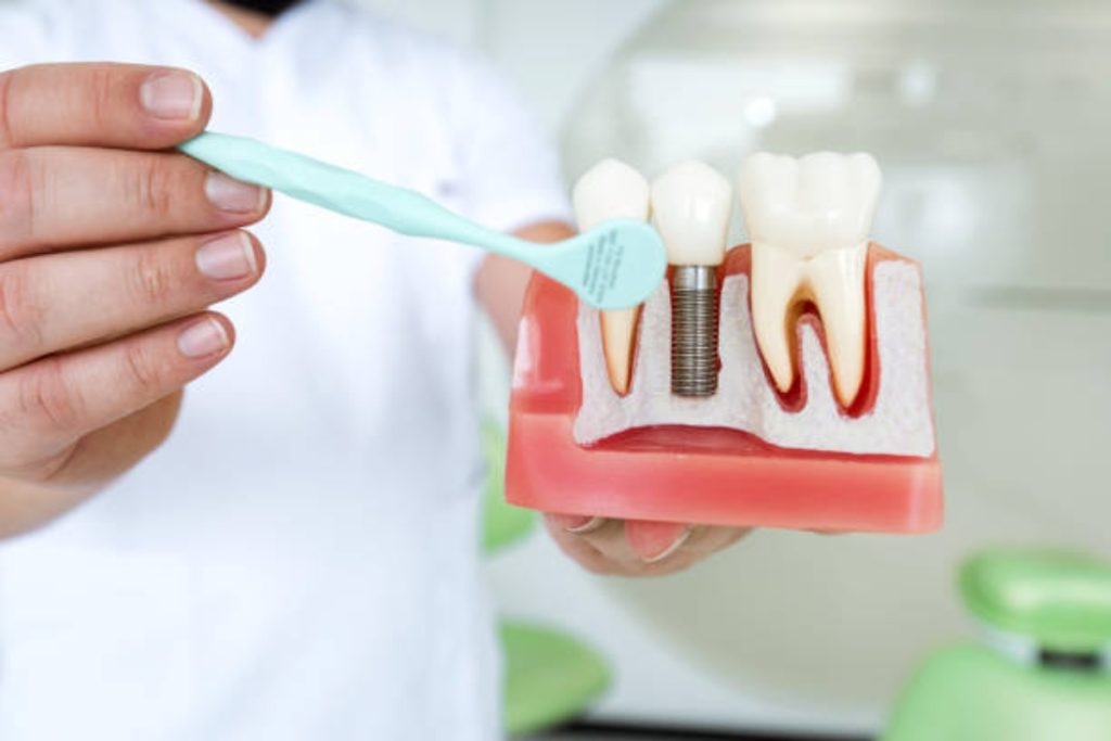 why dental implants fail