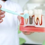 why dental implants fail