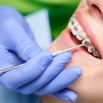 signs you may need orthodontic treatment