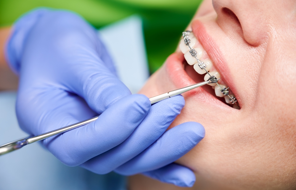signs you may need orthodontic treatment