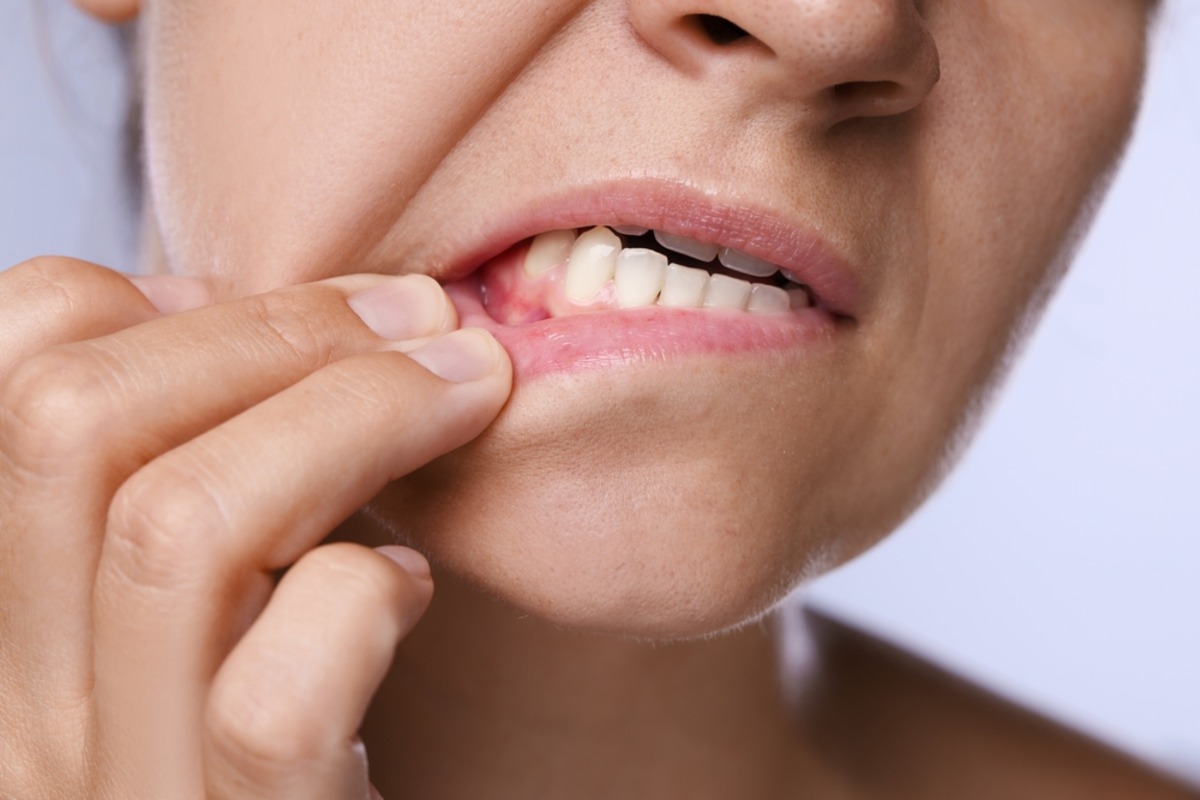 signs of gum graft surgery