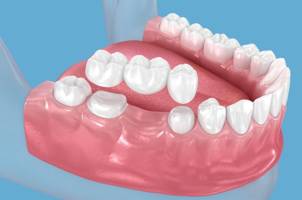 dental bridge for extracted teeth