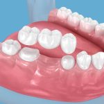 dental bridge for extracted teeth