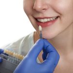veneers for teeth damaged by grinding